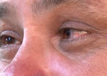 11 pacientes perdem a visão de um dos olhos após cirurgia de catarata