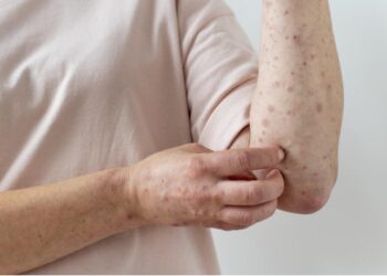 Risco de sarampo sobe após a Copa, diz Ministério da Saúde