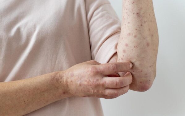 Risco de sarampo sobe após a Copa, diz Ministério da Saúde