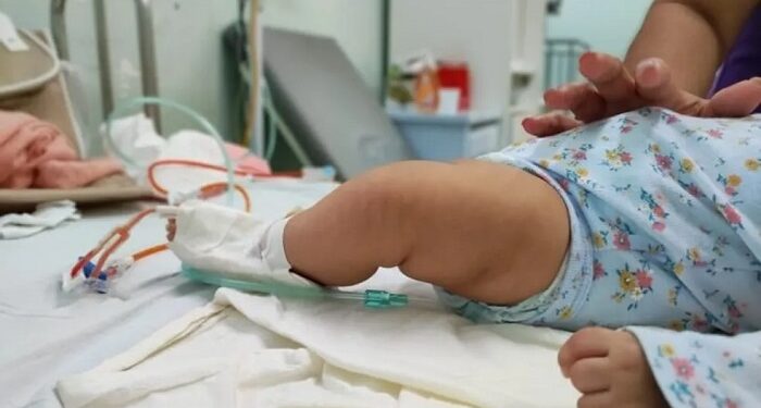 Síndrome Respiratória Aguda Grave sobe entre bebês no Brasil