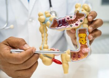 Câncer colorretal: SUS ganha novo teste de rastreio